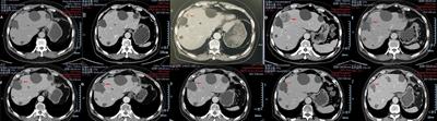 Case Report: Toripalimab Combined With Anlotinib in a Patient With Metastatic Upper Tract Urothelial Carcinoma After Pembrolizumab Failure